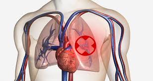 Plicní embolie je život ohrožující onemocnění cévního systému, při němž dochází ke snížení průtoku krve plicním řečištěm. Zname Ucinny Prirodni Lek Na Hojeni Plicni Embolie Www Vitalitis Cz