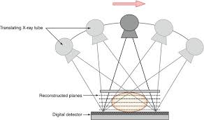 Digital Mammography And Digital Breast Tomosynthesis Springerlink