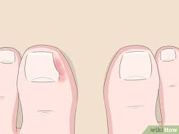 5 ways to relieve ingrown toe nail pain