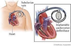 Permanent pacemaker leads are placed via thoracotomy or transvenously, but some temporary emergency pacemaker leads can be placed on. Icd Implantable Cardioverter Defibrillator Placement What To Expect At Home