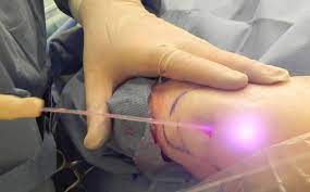 slimlipo laser liposuction advanes