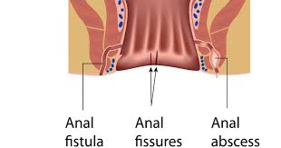 fissure in crohn s disease uc