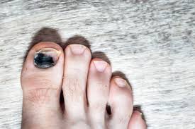 black toenails bye bye toenail fungus