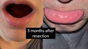 lower lip p mucocele verus mucus