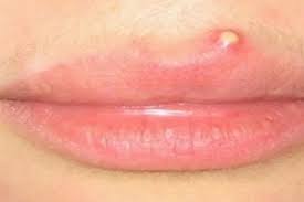 understanding pimples on the lips when