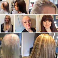 Hereditary factors are among the common causes of hair loss in women. Hair Solved Pa Twitter Did You Know Our Enhancer System Is Suitable For Partial Or Total Hair Loss And For All Causes From Conditions Such As Alopecia Or Trich To Genetic Thinning