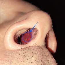Krwawienie z nosa - Poradnik Laryngologii