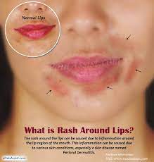 what causes rashes around the lips