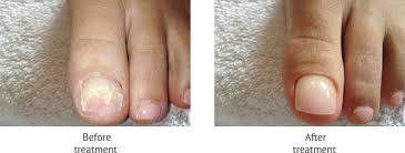 cosmetic nail repair foot doctor long