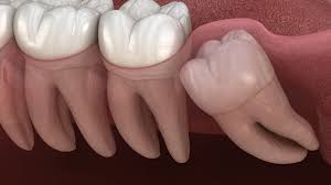 wisdom teeth removal surgery