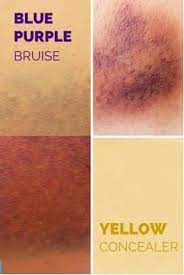 how to conceal a bruise