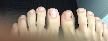 weird bruises on toenails picture