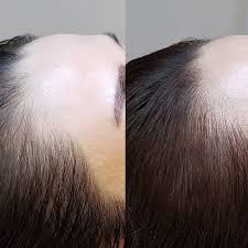 hairline microblading