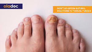 natural solutions to toenail fungus