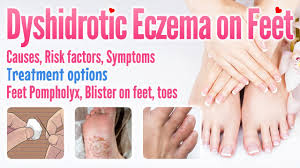 dyshidrotic eczema on feet causes