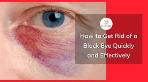 how to get rid of a black eye quickly