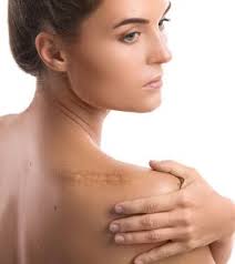 get rid of old scars treatment
