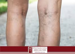 spider veins are a sign of a deeper
