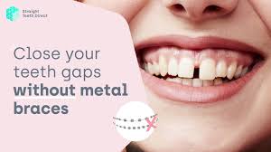 say goodbye to teeth gaps no braces