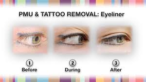 permanent makeup tattoo removal npm