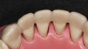 Sign of gum disease : Periodontal Splinting Dms Dentistry