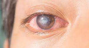 corneal ulcer optometrist in florence