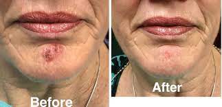 cold sore herpetic lesion laser