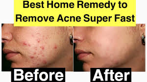 how to remove acne pimples fast