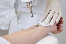 laser tattoo removal clinica joelle