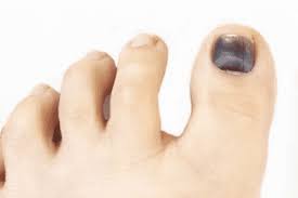 black toenails ps and bruises