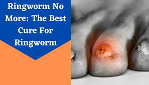 ringworm treatments for humans