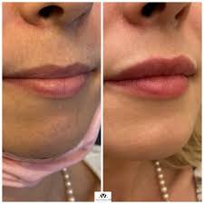 russian lip technique by dr avaliani