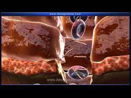 A condition, usually resulting in pain and dysmenorrhea, that is characterized by the abnormal occurrence of functional endometrial tissue. Gujarati Blood Clotting Youtube