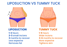 liposuction vs tummy tuck the