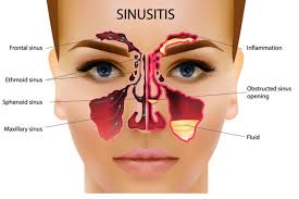sinus problems natural solutions that