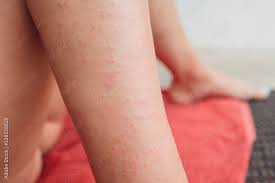 dermais herpetiformis skin rash in a