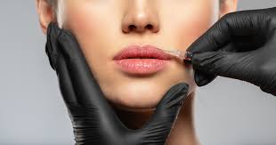 botox lip flip versus lip filler which