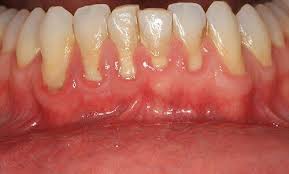 gum disease prevention and treatment