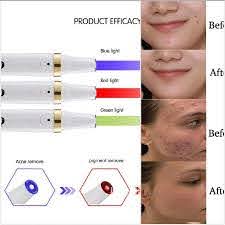 Bio Acne Removal Pen Acne Laser Pen With Topical Heating And Led Blue Light Therapy Acne Treatment Pimple Remover Home Use Beauty Devices Aliexpress