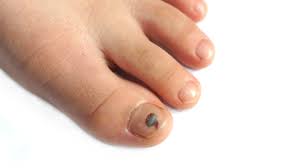 toenail turns black