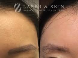 permanent makeup removal new york ny