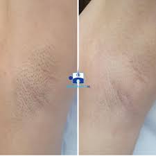 laser hair removal at skin care
