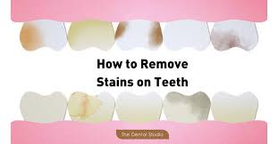 The first two weeks after you've stopped smoking for good are very critical. Common Causes Of Stains On Teeth And How To Treat Them The Dental Studio