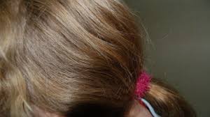 24 yrs old female asked about lice in my baby hair, 1 doctor answered this and 32 people found it useful. Pictures Of Head Lice On Hair