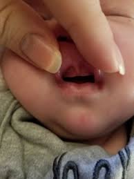 upper lip tie babycenter