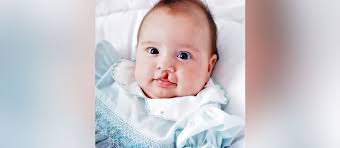 cleft lip and palate surgery timeline