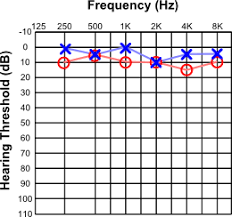 Audiogram Interpretation For Gp Registrars Gp Trove