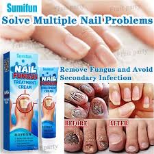 nail fungus treatment anti fungal cream