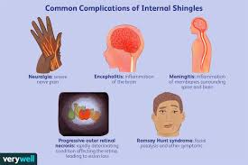 what is internal shingles