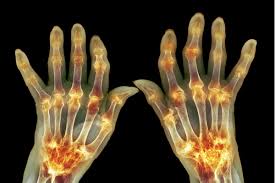 Rheumatoid arthritis causing hand or finger joint pain? Arthritis In The Fingers What You Need To Know